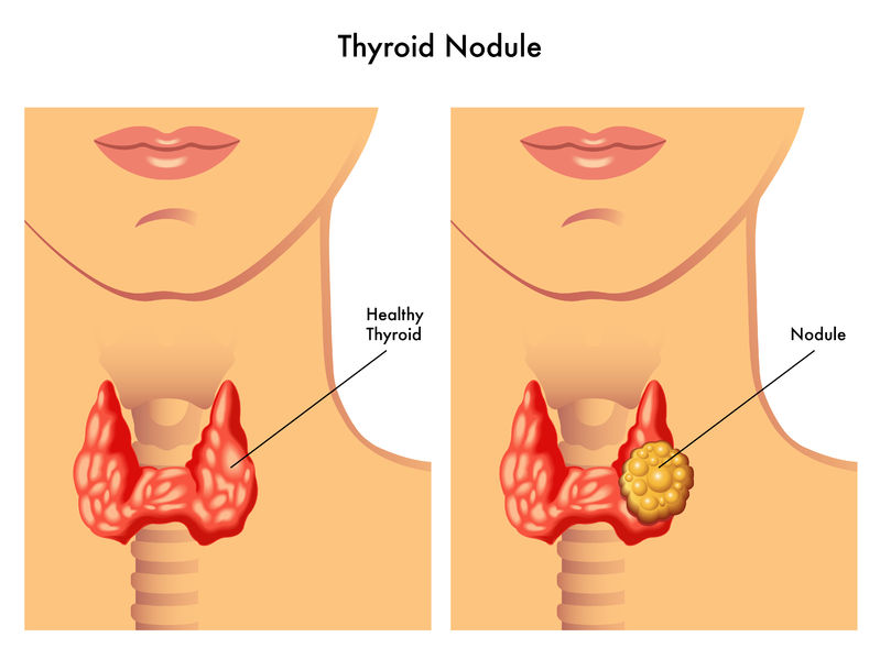 why-thyroid-nodules-need-to-be-surgically-removed